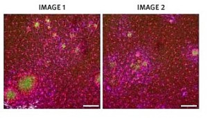 terapia-genetica_alzheimer